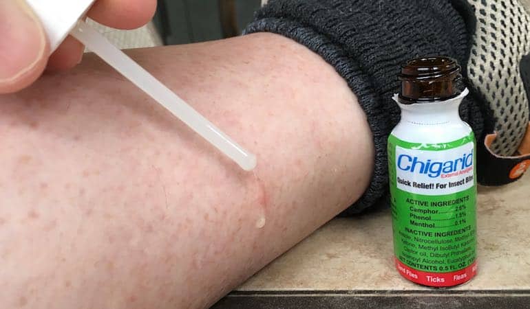 How To Treat Chigger Bites1