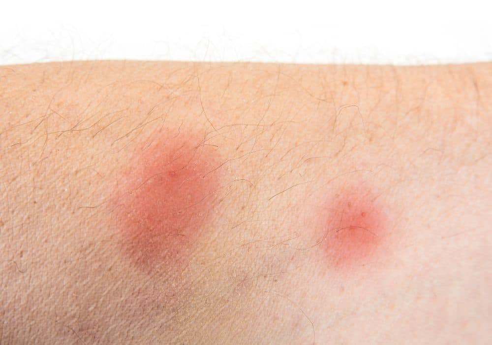 What Do Bed Bug Bites Look Like 1